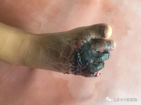 小儿骨科成功救治下肢干性坏疽患儿